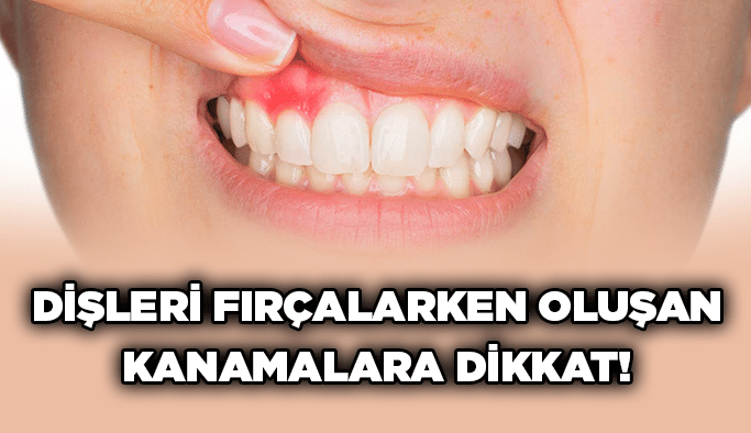 Dişleri fırçalarken oluşan kanamalara dikkat!