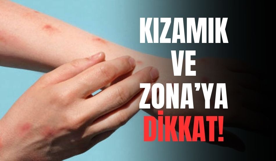 Covid-19 salgını sonrası viral hastalıklar coştu: Kızamık ve Zona’ya dikkat!