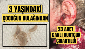 3 yaşındaki çocuğun kulağından 23 adet canlı kurtçuk çıkartıldı
