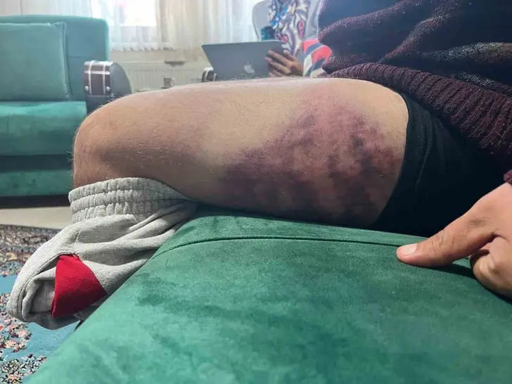 Otizmli Genç, Odunluğa Baktığı İçin Saldırıya Uğradı! Vicdanları Sarsan Şiddet Olayı