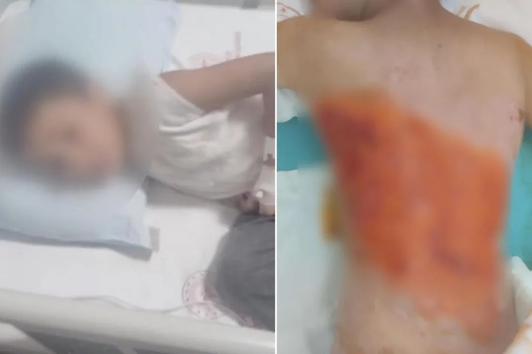Akranları tarafından sırtı yakılan 12 yaşındaki çocuk hastanede